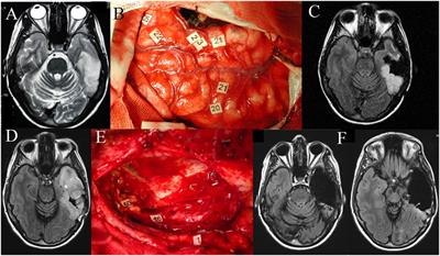 Network Plasticity and Intraoperative Mapping for Personalized Multimodal Management of Diffuse Low-Grade Gliomas